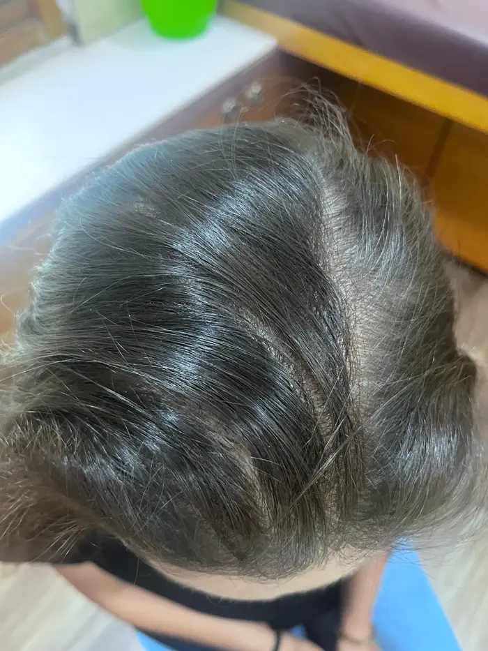 Female Pattern Baldness case 3 after treatment